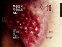 무릎상처 무릅쓰고 있다.